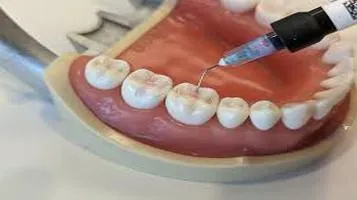 Dental Sealants: A Comprehensive Review